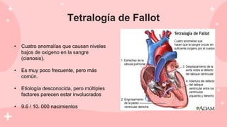 Tetralogía de Fallot
• Cuatro anomalías que causan niveles
bajos de oxigeno en la sangre
(cianosis).
• Es muy poco frecuente, pero más
común.
• Etiología desconocida, pero múltiples
factores parecen estar involucrados
• 9.6 / 10. 000 nacimientos
 