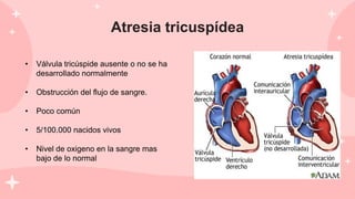 Atresia tricuspídea
• Válvula tricúspide ausente o no se ha
desarrollado normalmente
• Obstrucción del flujo de sangre.
• Poco común
• 5/100.000 nacidos vivos
• Nivel de oxigeno en la sangre mas
bajo de lo normal
 