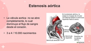 Estenosis aórtica
• La válvula aortica no se abre
completamente, lo cual
disminuye el flujo de sangre
desde el corazón.
• 3 a 4 / 10.000 nacimientos
 