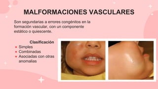 Clasificación
● Simples
● Combinadas
● Asociadas con otras
anomalias
MALFORMACIONES VASCULARES
Son segundarias a errores congénitos en la
formación vascular, con un componente
estático o quiescente.
 