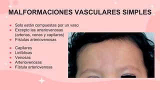 MALFORMACIONES VASCULARES SIMPLES
● Solo están compuestas por un vaso
● Excepto las arteriovenosas
(arterias, venas y capilares)
● Fístulas arteriovenosas
● Capilares
● Linfáticas
● Venosas
● Arteriovenosas
● Fístula arteriovenosa
 