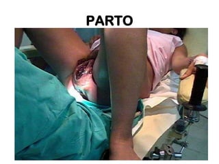 PARTO

 