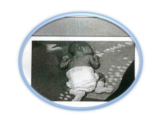 Desarrollo normal del bebè.