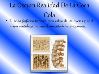 • El ácido fosfórico también roba calcio de los huesos y es el
mayor contribuyente para el aumento de la osteoporosis.
La Oscura Realidad De La Coca
Cola
 