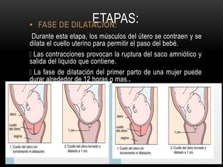 ETAPAS:• FASE DE DILATACIÓN:
Durante esta etapa, los músculos del útero se contraen y se
dilata el cuello uterino para permitir el paso del bebé.
Las contracciones provocan la ruptura del saco amniótico y
salida del liquido que contiene.
La fase de dilatación del primer parto de una mujer puede
durar alrededor de 12 horas o mas..
 