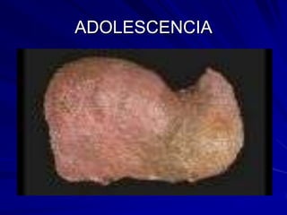 ADOLESCENCIA
 