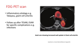 FDG-PET scan
• Inflammatory etiology e.g.
Takayasu, giant cell arteritis
• Follow up after TEVAR, EVAR
for specific complications e.g.
infections
Axial cuts showing increased wall uptake in Giant cell arteritis
Hayashida et al., Nuclear Medicine/Molecular Imaging 2010.
 