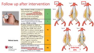 Follow up after intervention
Nitinol stents
Endo-leak
25%
 