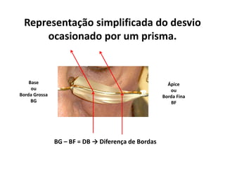 Representação simplificada do desvio
ocasionado por um prisma.
Ápice
ou
Borda Fina
BF
Base
ou
Borda Grossa
BG
BG – BF = DB → Diferença de Bordas
 