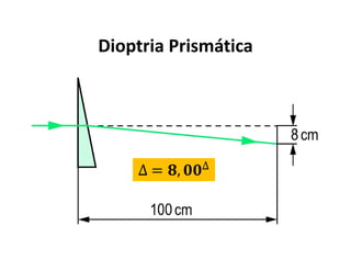 Dioptria Prismática
∆ = , ∆
 