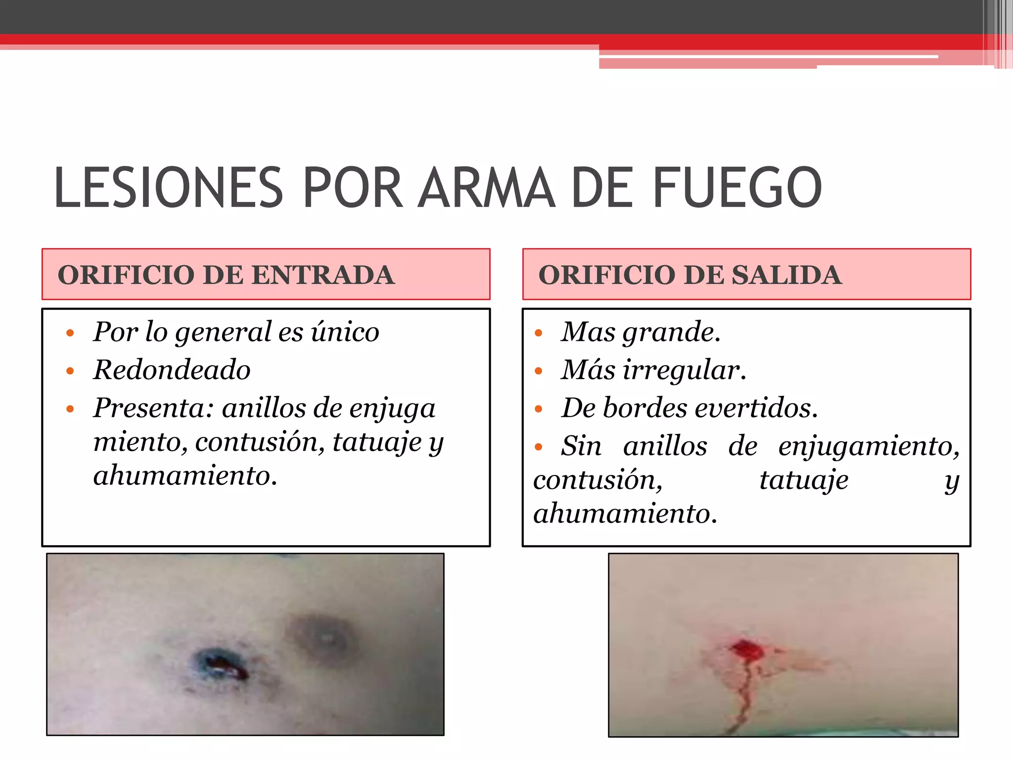 LESIONES POR ARMA DE FUEGOORIFICIO DE ENTRADAORIFICIO DE SALIDAPor lo general es únicoRedondeadoPresenta: anillos de enjuga miento, contusión, tatuaje y ahumamiento.Mas grande.Más irregular.De bordes evertidos.Sin anillos de enjugamiento, contusión, tatuaje y ahumamiento.