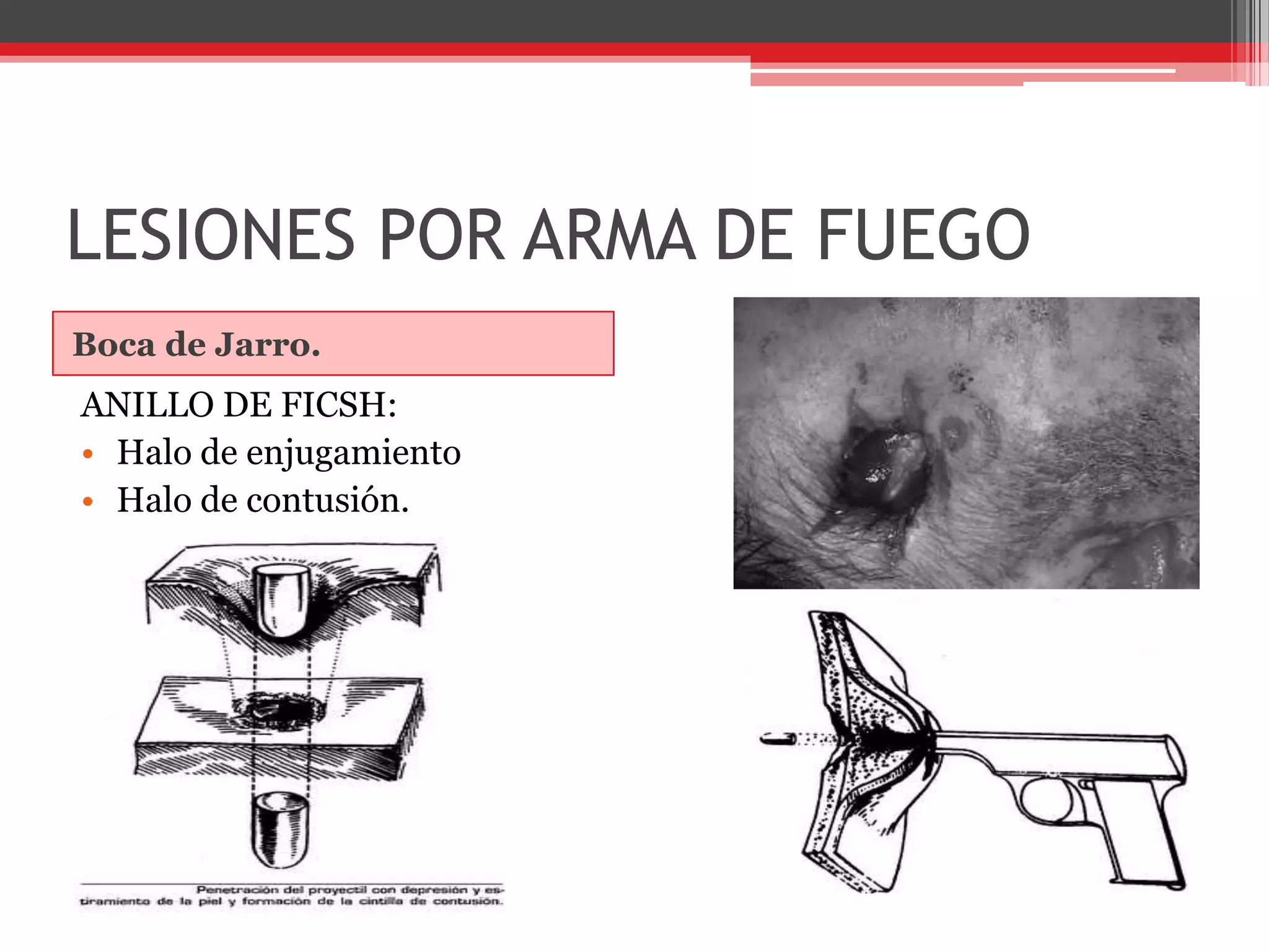 LESIONES POR ARMA DE FUEGOBoca de Jarro.ANILLO DE FICSH:Halo de enjugamientoHalo de contusión.