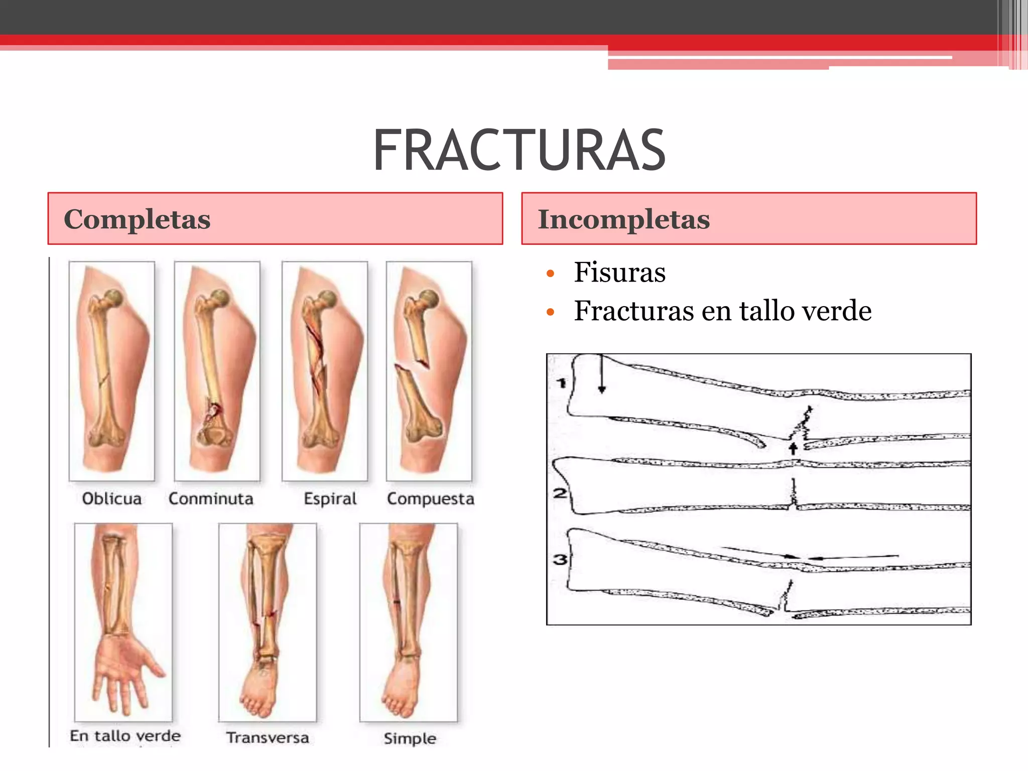 FRACTURASCompletasIncompletasFisurasFracturas en tallo verde