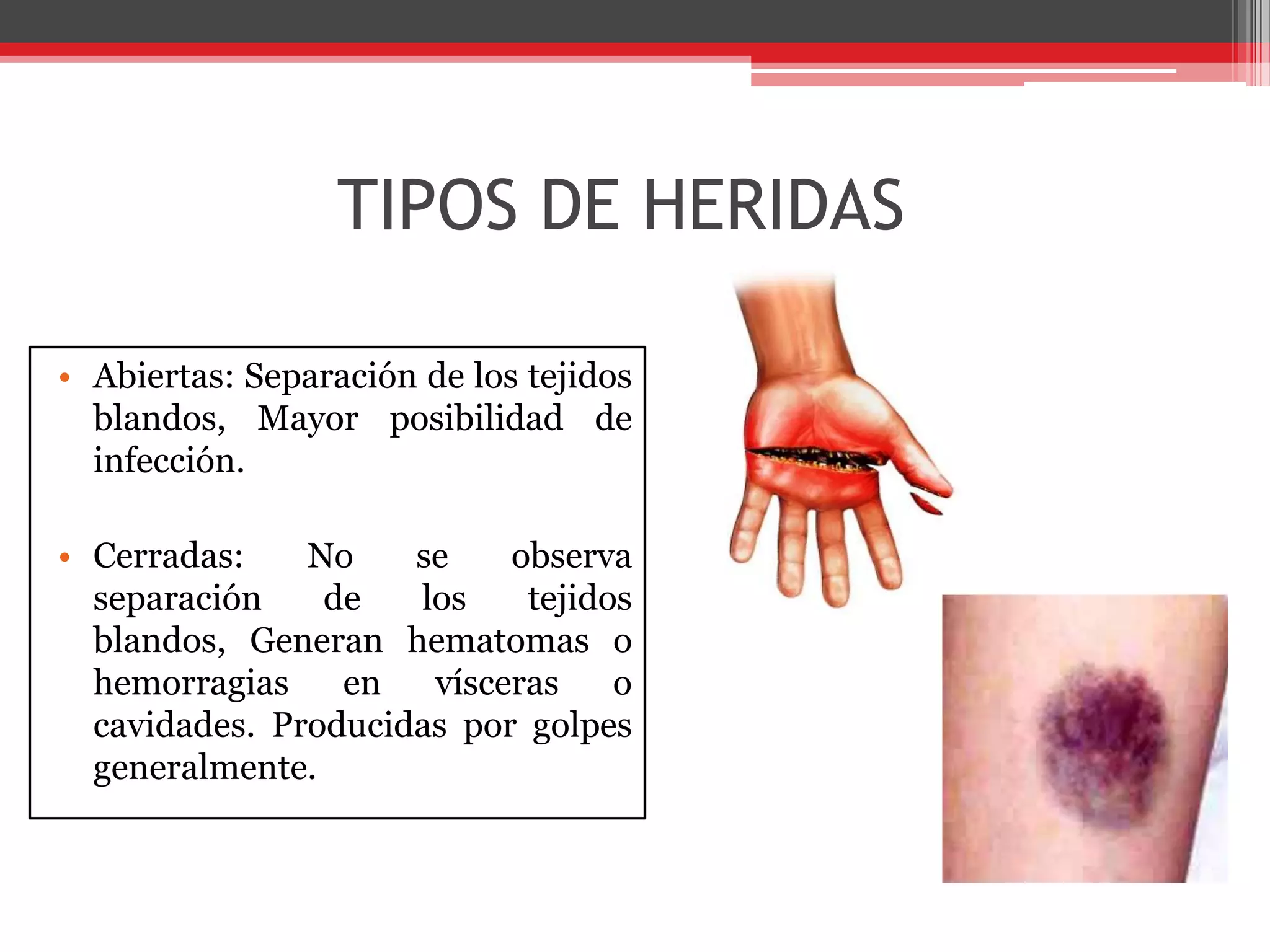 TIPOS DE HERIDASAbiertas: Separación de los tejidos blandos, Mayor posibilidad de infección.Cerradas: No se observa separación de los tejidos blandos,Generan hematomas o hemorragias en vísceras o cavidades. Producidas por golpes generalmente.
