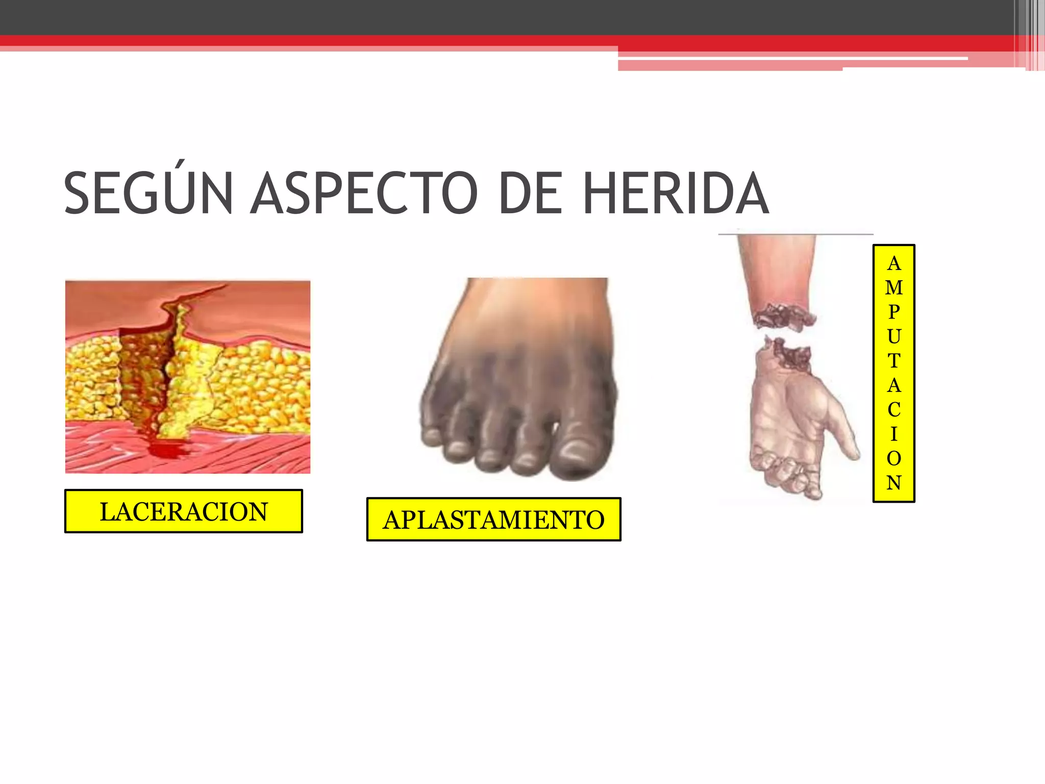 SEGÚN ASPECTO DE HERIDAAMPUTACIONLACERACIONAPLASTAMIENTO