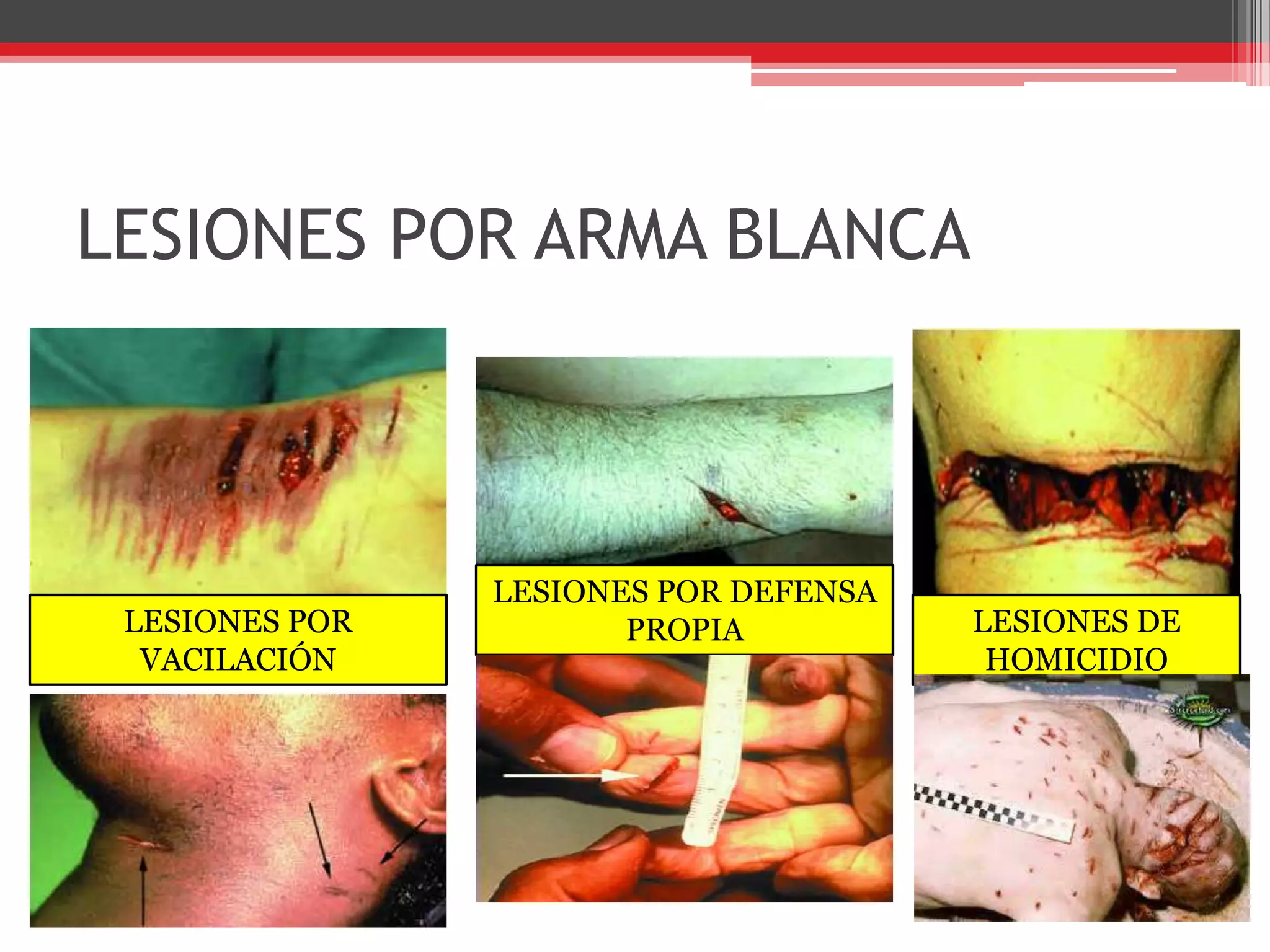 LESIONES POR ARMA BLANCALESIONES POR DEFENSA PROPIALESIONES POR VACILACIÓNLESIONES DE  HOMICIDIO