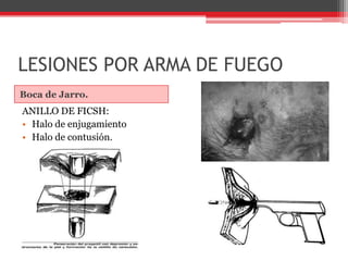 LESIONES POR ARMA DE FUEGOBoca de Jarro.ANILLO DE FICSH:Halo de enjugamientoHalo de contusión.