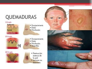 QUEMADURAS