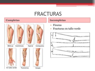 FRACTURASCompletasIncompletasFisurasFracturas en tallo verde