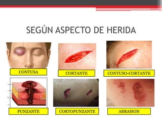 SEGÚN ASPECTO DE HERIDACONTUSACORTANTECONTUSO-CORTANTEPUNZANTECORTOPUNZANTEABRASION