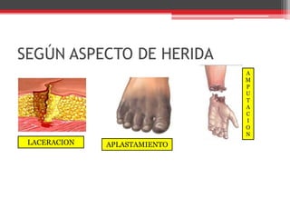 SEGÚN ASPECTO DE HERIDAAMPUTACIONLACERACIONAPLASTAMIENTO
