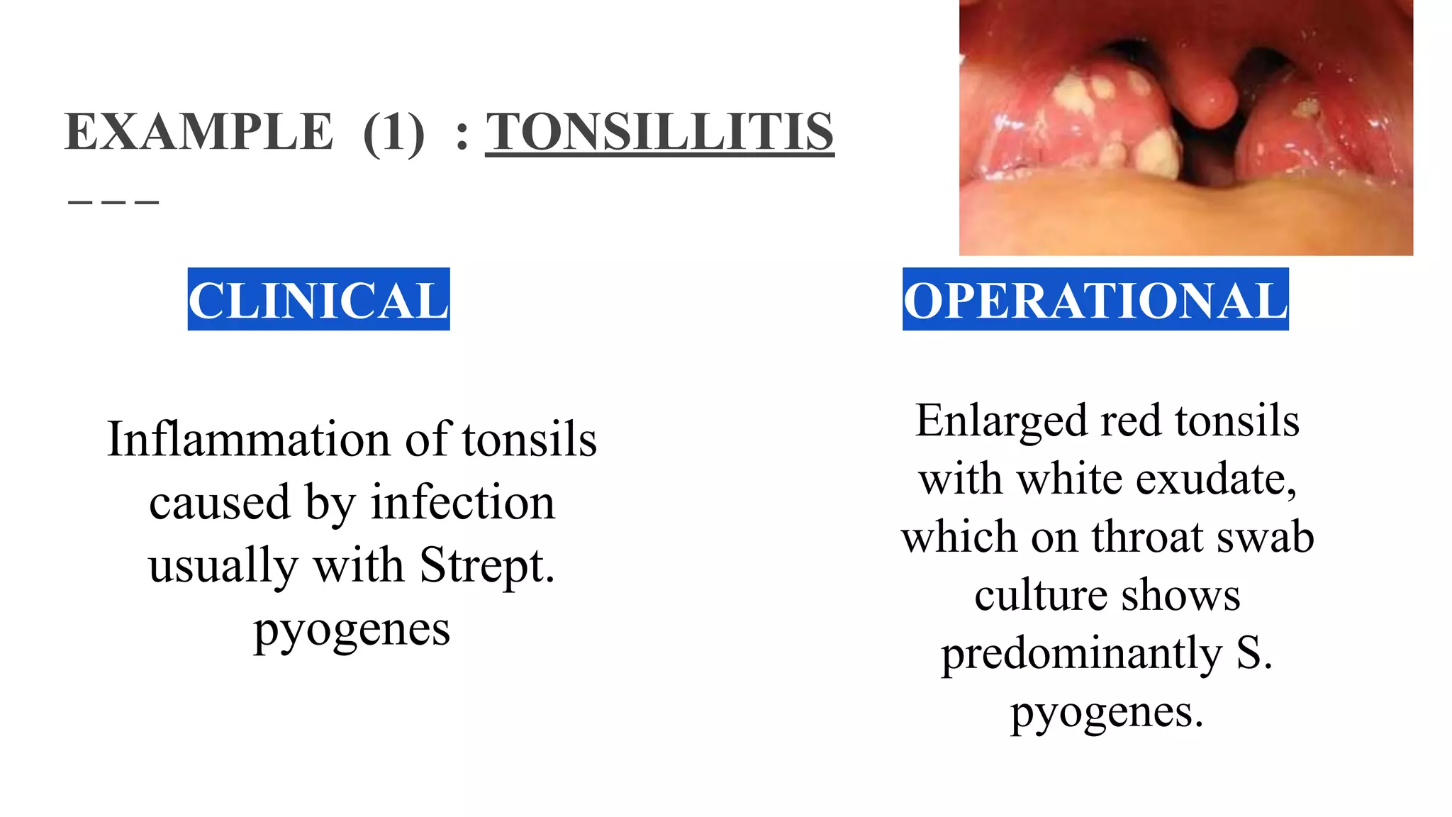 EXAMPLE (1) : TONSILLITIS
CLINICAL OPERATIONAL
Inflammation of tonsils
caused by infection
usually with Strept.
pyogenes
Enlarged red tonsils
with white exudate,
which on throat swab
culture shows
predominantly S.
pyogenes.
 