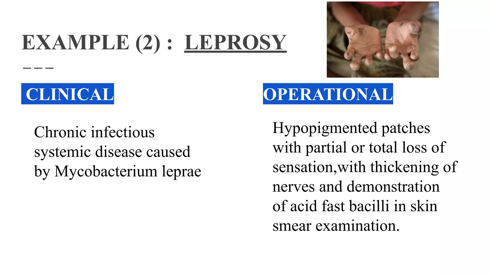 EXAMPLE (2) : LEPROSY
CLINICAL OPERATIONAL
Chronic infectious
systemic disease caused
by Mycobacterium leprae
Hypopigmented patches
with partial or total loss of
sensation,with thickening of
nerves and demonstration
of acid fast bacilli in skin
smear examination.
 