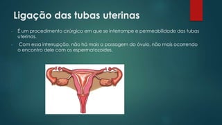 Ligação das tubas uterinas
- É um procedimento cirúrgico em que se interrompe e permeabilidade das tubas
uterinas.
- Com essa interrupção, não há mais a passagem do óvulo, não mais ocorrendo
o encontro dele com os espermatozoides.
 