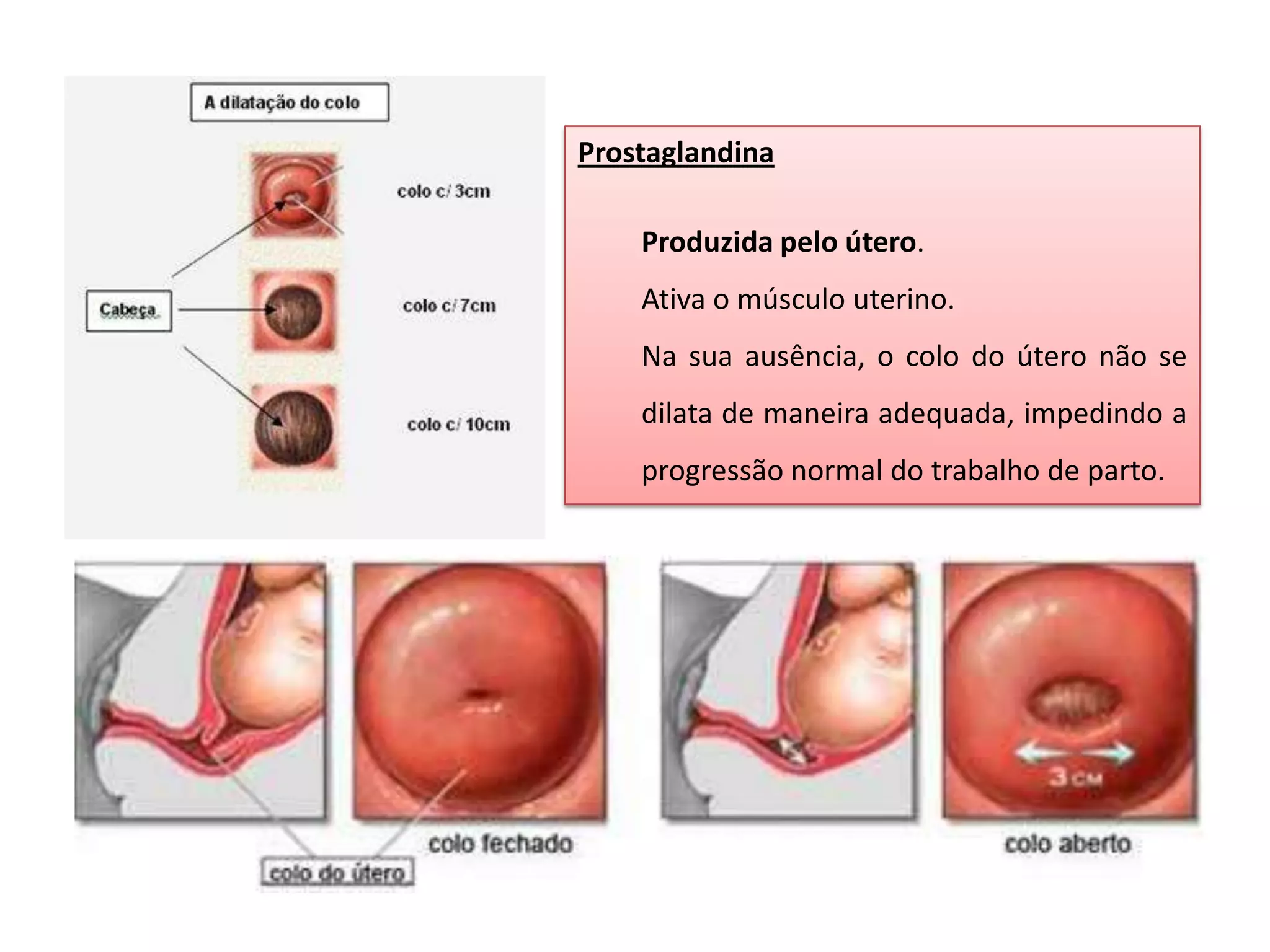 Prostaglandina
Produzida pelo útero.
Ativa o músculo uterino.
Na sua ausência, o colo do útero não se
dilata de maneira adequada, impedindo a

progressão normal do trabalho de parto.

 