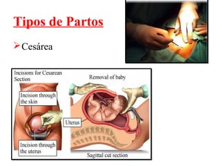 Tipos de Partos
 Cesárea
 