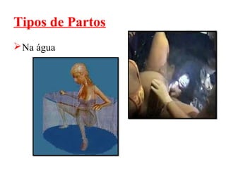 Tipos de Partos
 Na água
 