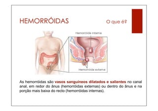 HEMORRÓIDAS                                     O que é?




As hemorróidas são vasos sanguíneos dilatados e salientes no canal
anal, em redor do ânus (hemorróidas externas) ou dentro do ânus e na
porção mais baixa do recto (hemorróidas internas).
 