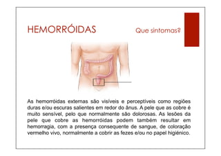 HEMORRÓIDAS                                  Que sintomas?




As hemorróidas externas são visíveis e perceptíveis como regiões
duras e/ou escuras salientes em redor do ânus. A pele que as cobre é
muito sensível, pelo que normalmente são dolorosas. As lesões da
pele que cobre as hemorróidas podem também resultar em
hemorragia, com a presença consequente de sangue, de coloração
vermelho vivo, normalmente a cobrir as fezes e/ou no papel higiénico.
 