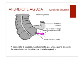 APENDICITE AGUDA                        Quais as causas?




 A apendicite é causada, habitualmente, por um pequeno bloco de
 fezes endurecidas (fecalito) que obstrui o apêndice.
 