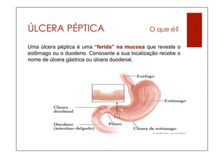ÚLCERA PÉPTICA                                 O que é?

Uma úlcera péptica é uma “ferida” na mucosa que reveste o
estômago ou o duodeno. Consoante a sua localização recebe o
nome de úlcera gástrica ou úlcera duodenal.
 