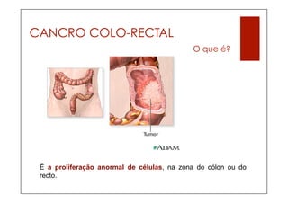 CANCRO COLO-RECTAL
                                            O que é?




 É a proliferação anormal de células, na zona do cólon ou do
 recto.
 