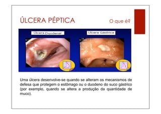 ÚLCERA PÉPTICA                                 O que é?




Uma úlcera desenvolve-se quando se alteram os mecanismos de
defesa que protegem o estômago ou o duodeno do suco gástrico
(por exemplo, quando se altera a produção da quantidade de
muco).
 