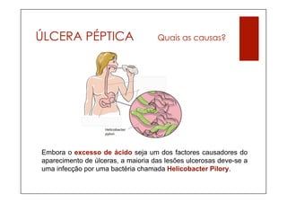 ÚLCERA PÉPTICA                      Quais as causas?




Embora o excesso de ácido seja um dos factores causadores do
aparecimento de úlceras, a maioria das lesões ulcerosas deve-se a
uma infecção por uma bactéria chamada Helicobacter Pilory.
 