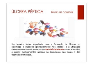 ÚLCERA PÉPTICA                        Quais as causas?




Um terceiro factor importante para a formação de úlceras no
estômago e duodeno (principalmente nos idosos) é a utilização
crónica ou em doses elevadas de anti-inflamatórios como a aspirina
e outros medicamentos usados no tratamento das dores e das
doenças reumáticas.
 