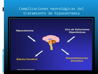 Complicaciones neurológicas del
  tratamiento de hiponatremia
 