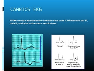 CAMBIOS EKG
El EKG muestra aplanamiento o inversión de la onda T, infradesnivel del ST,
onda U y arritmias auriculares o ventriculares.
 