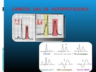 CAMBIOS EKG DE HIPERPOTASEMIA
 