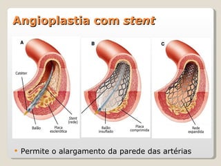 Angioplastia com  stent Permite o alargamento da parede das artérias 