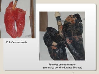 Pulmões saudáveis Pulmões de um fumador  (um maço por dia durante 20 anos) 
