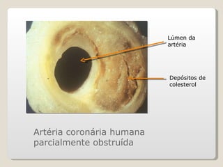 Artéria coronária humana parcialmente obstruída Lúmen da artéria Depósitos de colesterol 