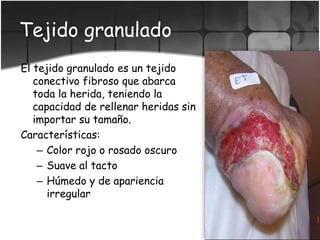 Tejido granulado
El tejido granulado es un tejido
conectivo fibroso que abarca
toda la herida, teniendo la
capacidad de rellenar heridas sin
importar su tamaño.
Características:
– Color rojo o rosado oscuro
– Suave al tacto
– Húmedo y de apariencia
irregular
 