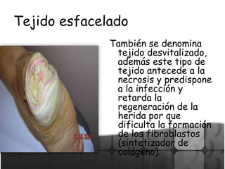 Tejido esfacelado
También se denomina
tejido desvitalizado,
además este tipo de
tejido antecede a la
necrosis y predispone
a la infección y
retarda la
regeneración de la
herida por que
dificulta la formación
de los fibroblastos
(sintetizador de
colágeno).
 