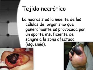 Tejido necrótico
La necrosis es la muerte de las
células del organismo que
generalmente es provocada por
un aporte insuficiente de
sangre a la zona afectada
(isquemia).
 