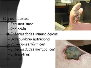 Otras causas:
– Traumatismos
– Radiación
– Enfermedades inmunológicas
– Desequilibrio nutricional
– Variaciones térmicas
– Enfermedades metabólicas
– Entre otros
 
