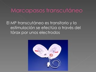 El MP transcutáneo es transitorio y la
   estimulación se efectúa a través del
   tórax por unos electrodos
 